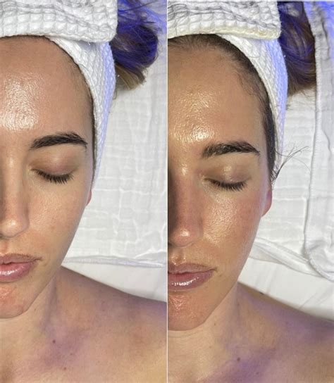 hydrafacial before and after.